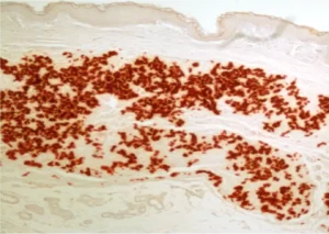 calcification of the elastic fibers in the middle part of the skin in a patient with a rare calcification disease, pseudoxanthoma elasticum