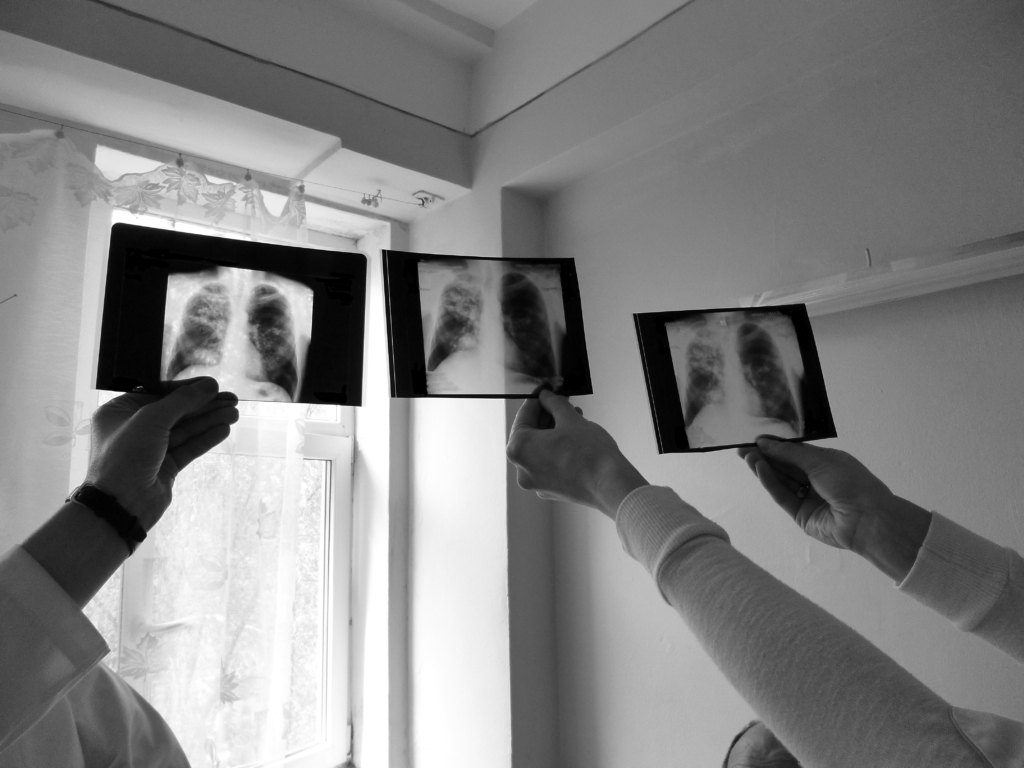 hand holding up an x-ray photo of a pair of lungs to inspect it